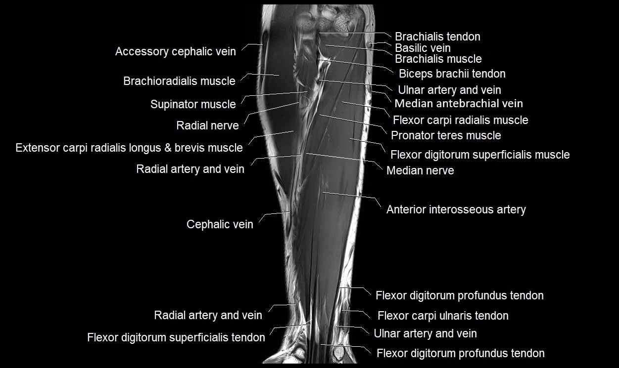 MRI 3T forearm coronal cross sectional anatomy image 9.webp